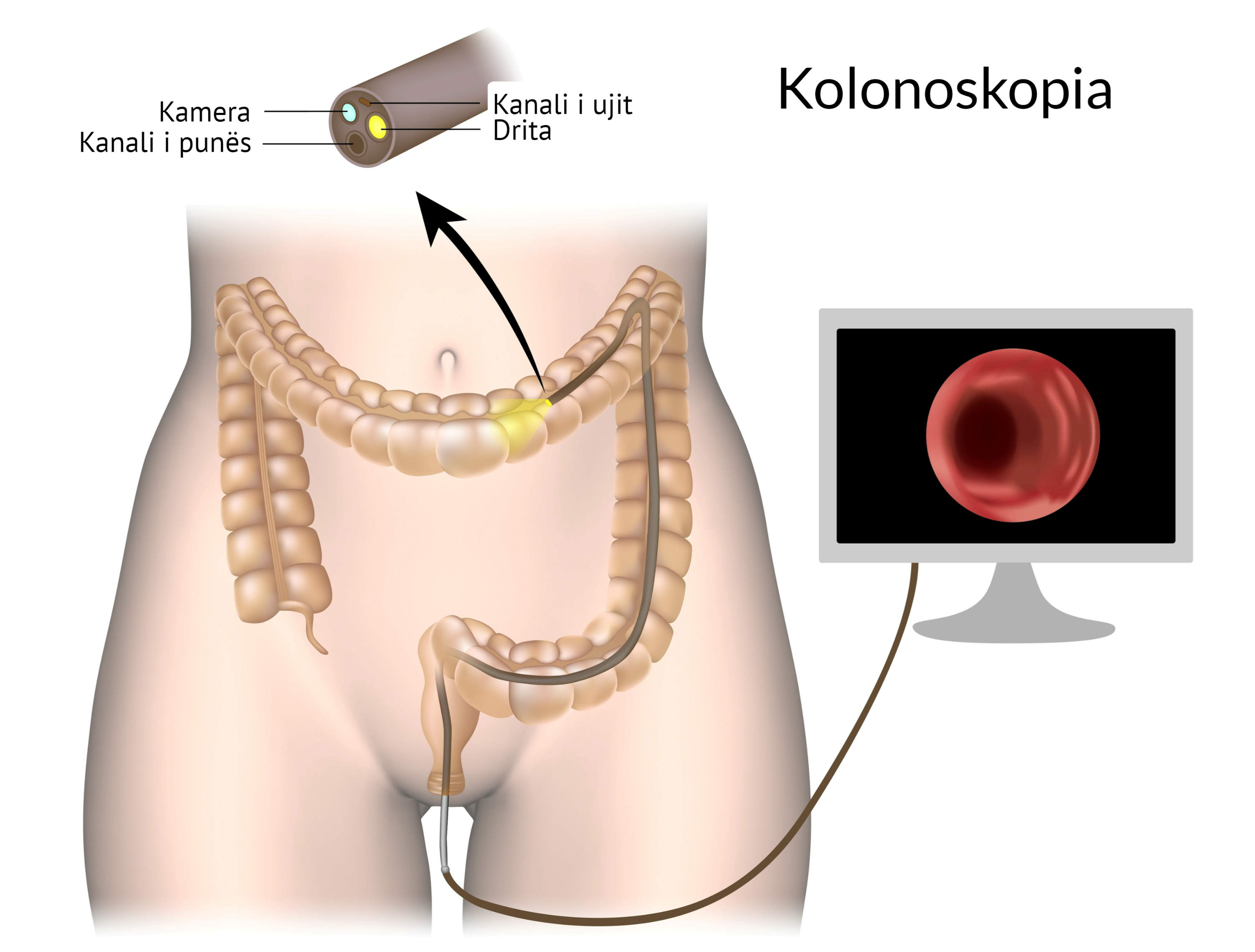 Diagram qe tregon si kryhet kolonoskopia me endoskop