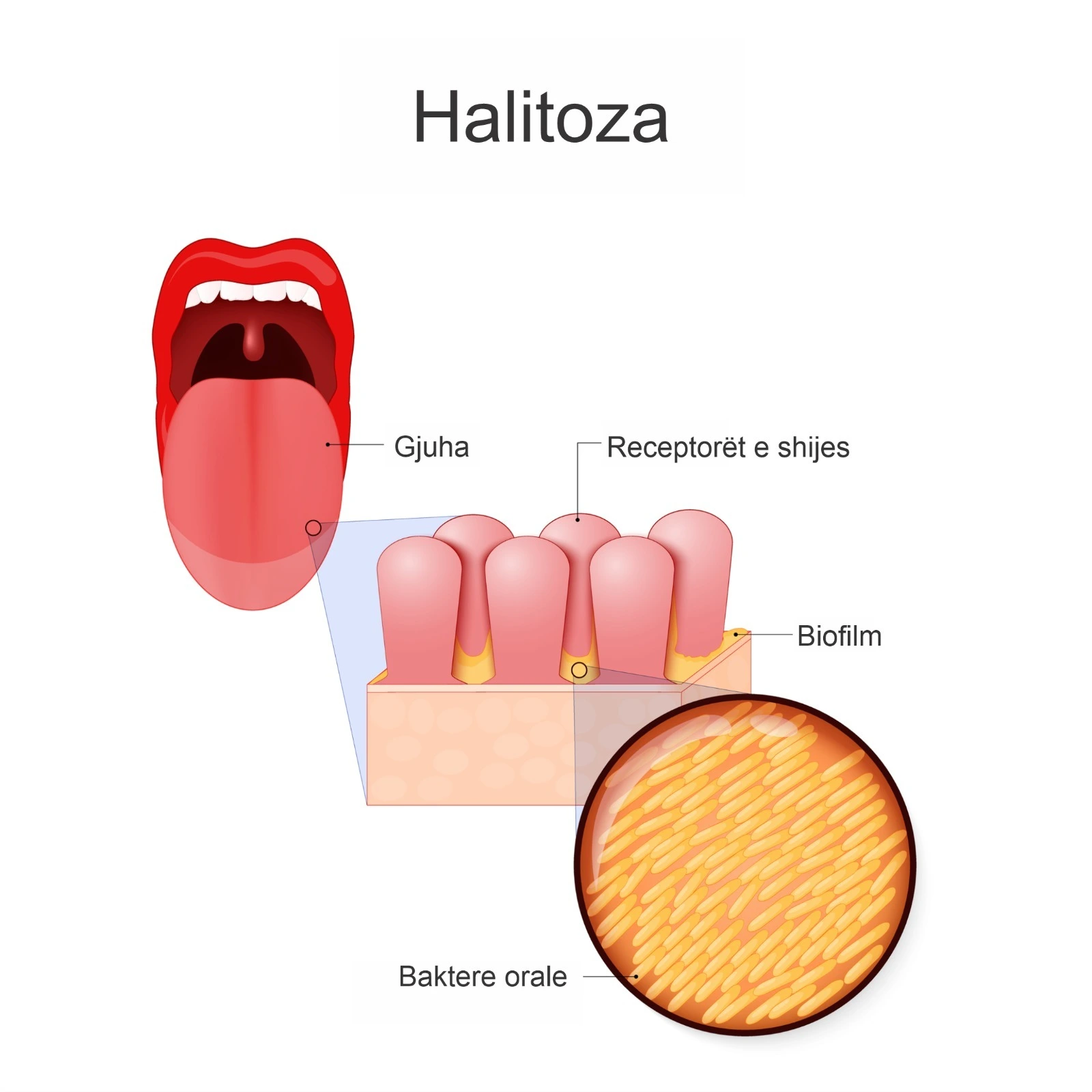Diagram që tregon halitozën, gjuhën dhe bakteret orale të grumbulluara në biofilm.