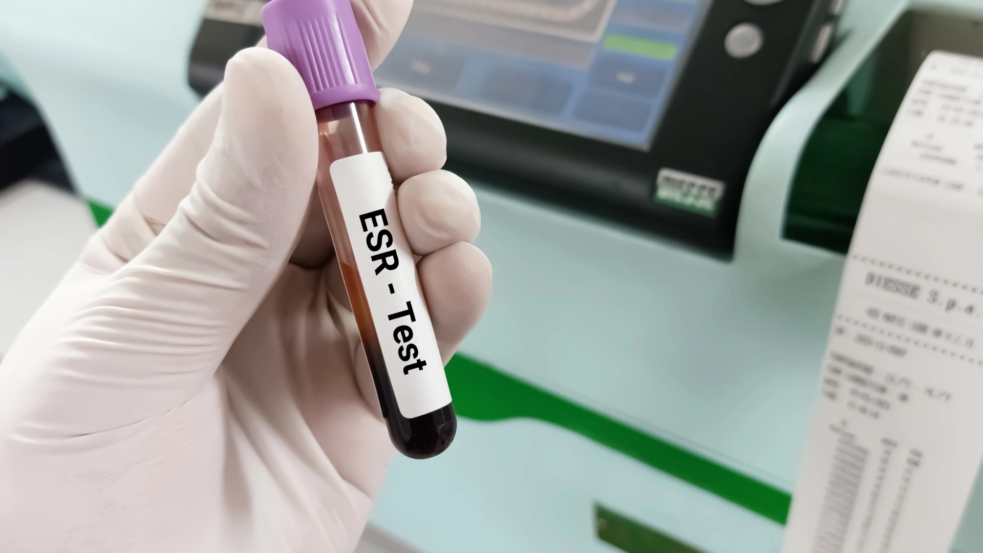Quest Stat Lab Esr ESR Test | Inflammation & Disease Detection Screening 🧪🩸