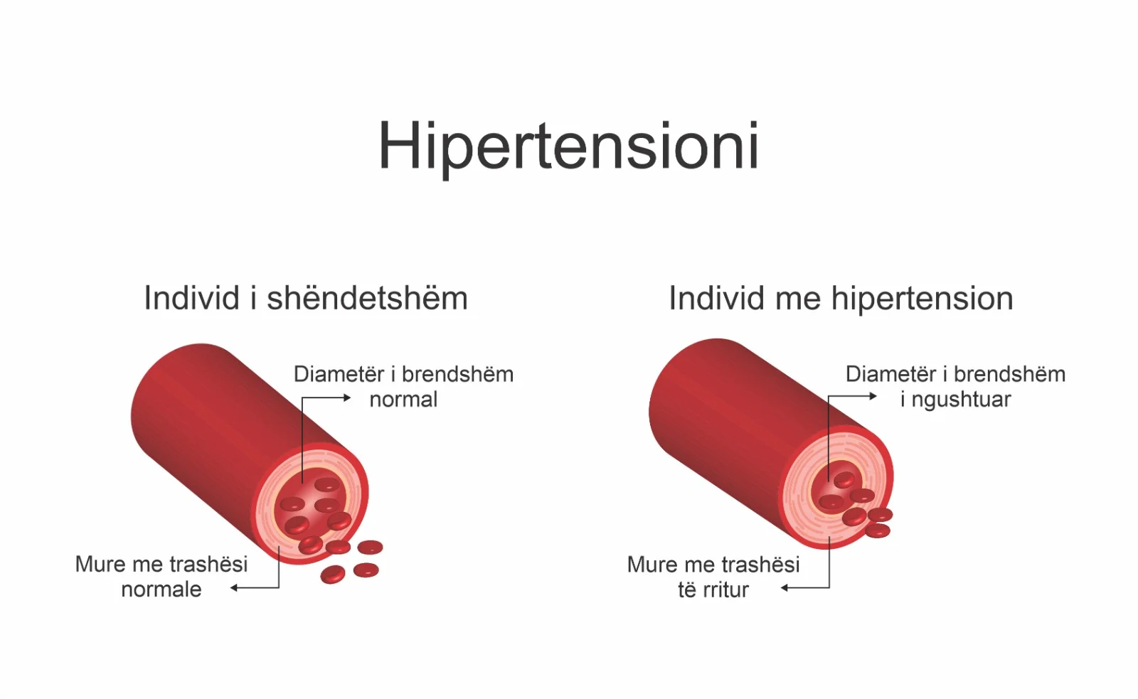 Diagram që krahason një enë gjaku normale me një enë gjaku të ngushtuar nga hipertensioni, duke treguar trashjen e mureve të arteries dhe vështirësimin e qarkullimit të gjakut.