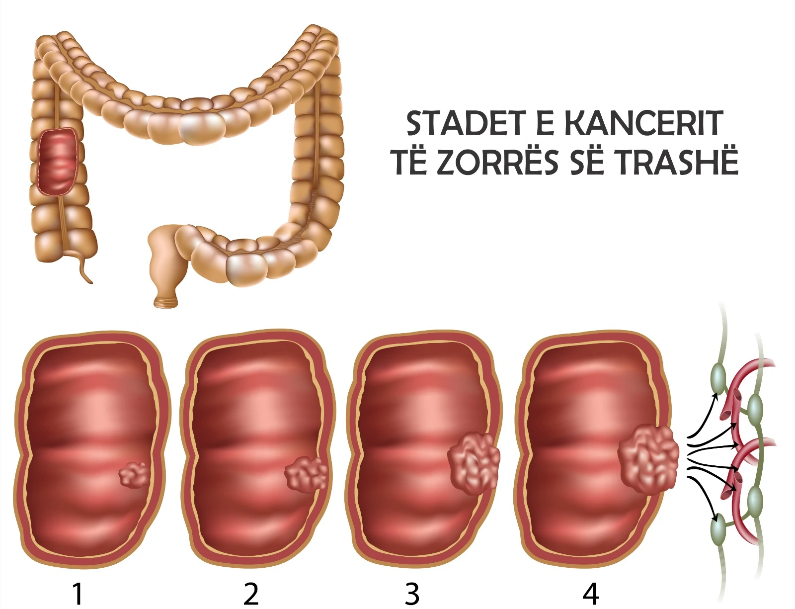 Diagram qe tregon stadet e kancerit te zorres se trashe nga faza fillestare deri ne perhapje ne nyjet limfatike