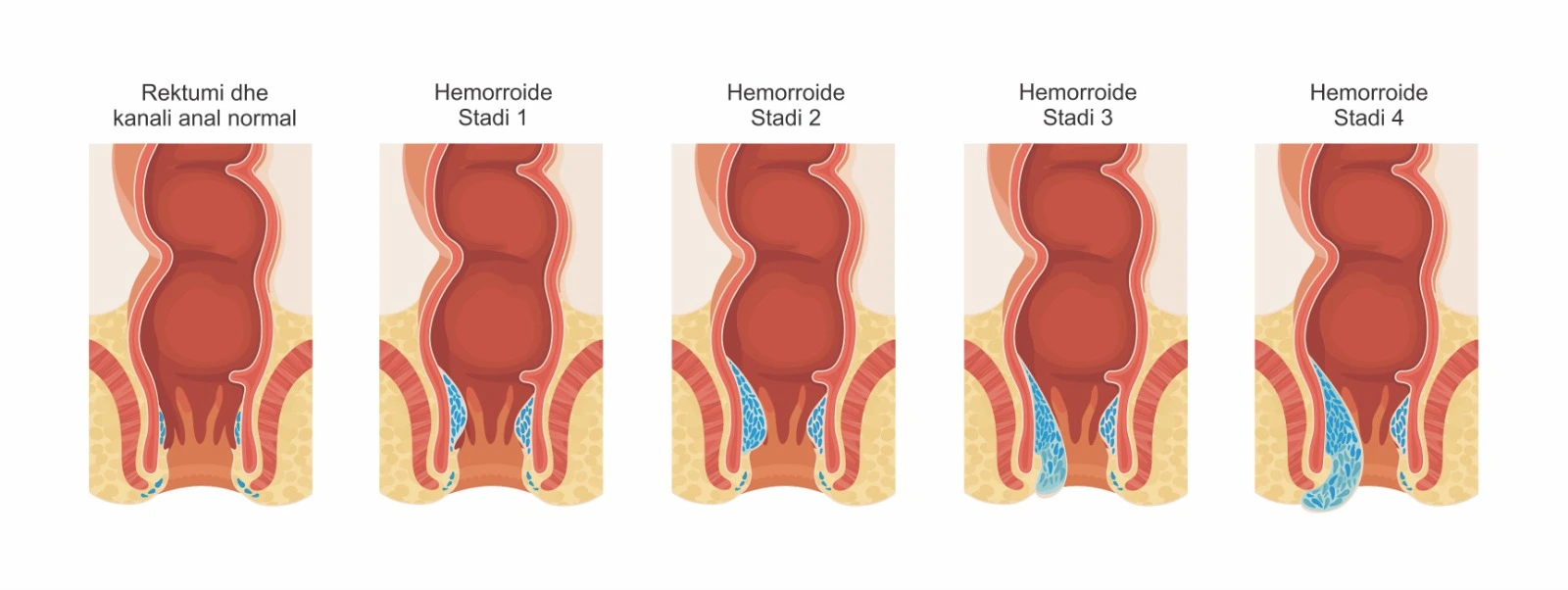 Diagram që tregon stadet e hemorroideve nga kanali anal normal deri te hemorroidet stadi 1, 2, 3 dhe 4.