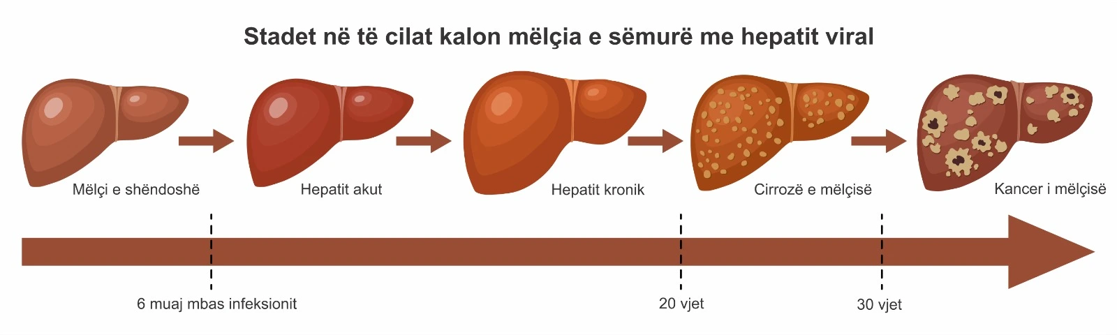 Diagram që tregon stadet e hepatitit viral nga mëlçia e shëndetshme deri te cirroza dhe kanceri i mëlçisë.