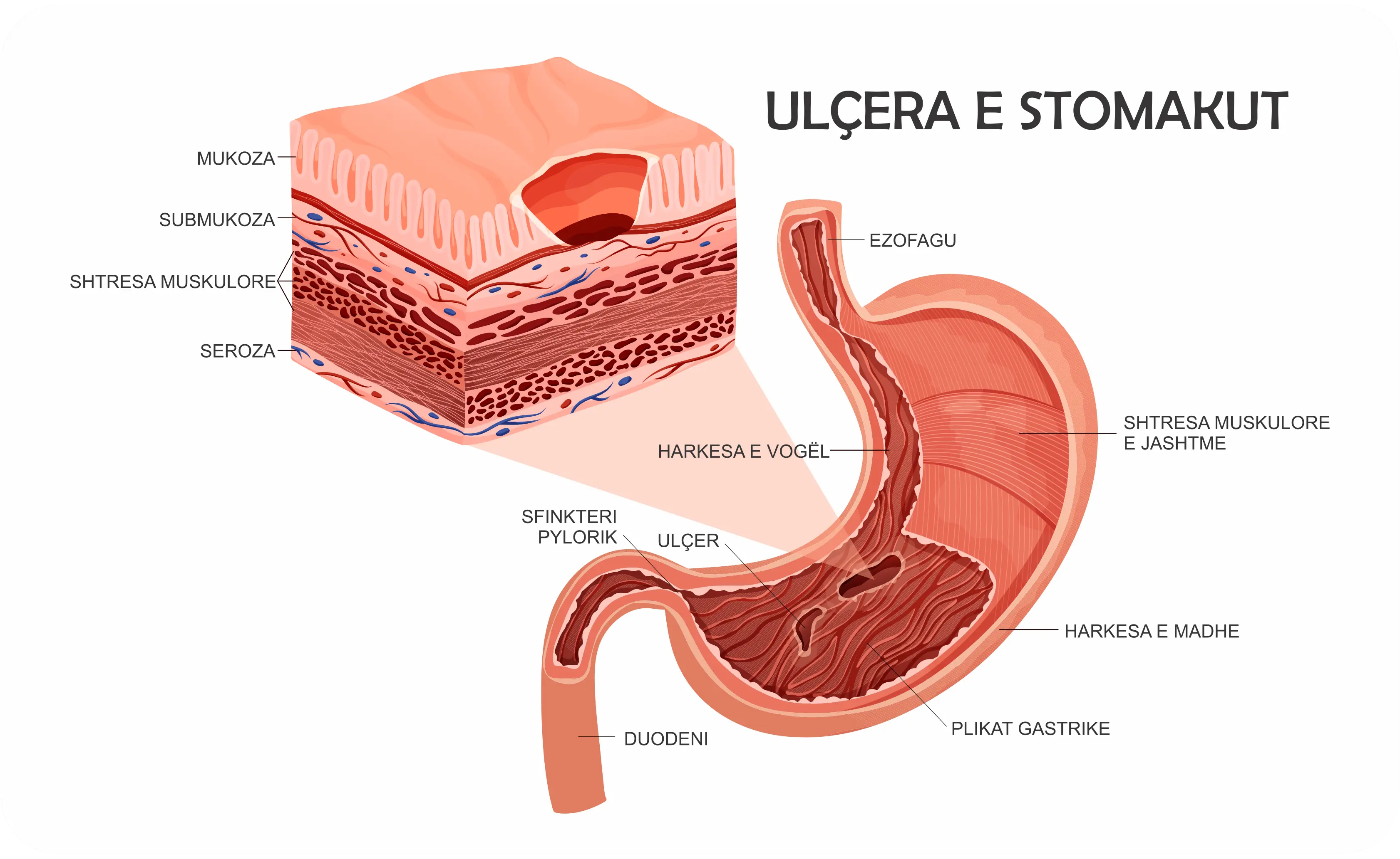  Ilustrim i ulçeres se stomakut me paraqitjen e lezionit ne murin gastrik dhe strukturat si ezofagu dhe duodeni